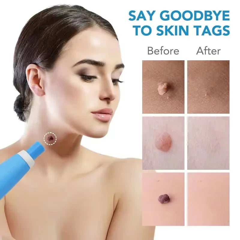 Skin Tag Remover