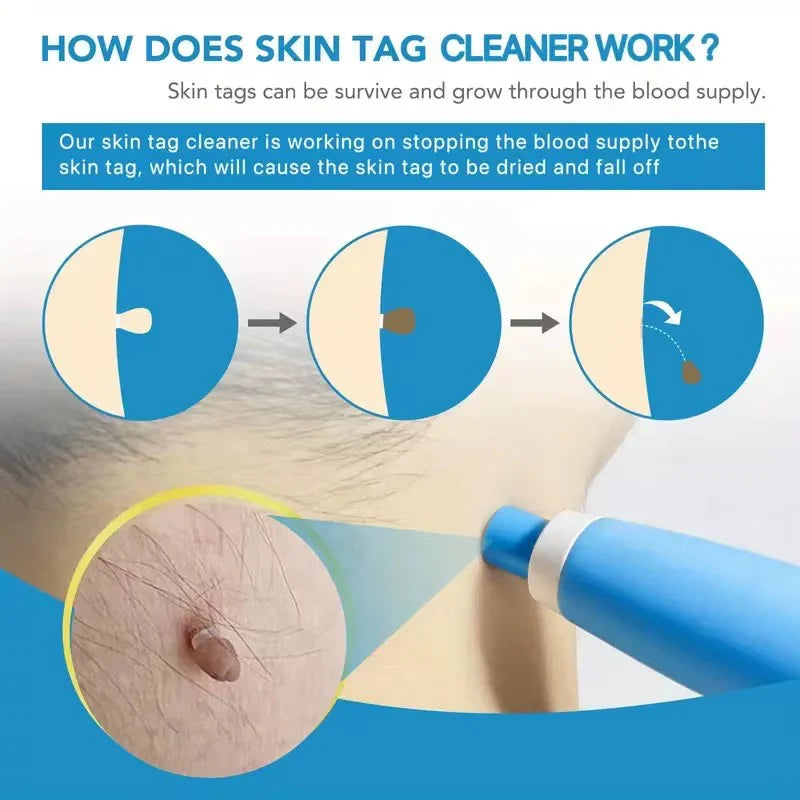 Skin Tag Remover