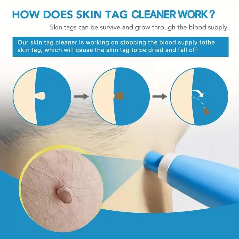 Skin Tag Remover bazona.com
