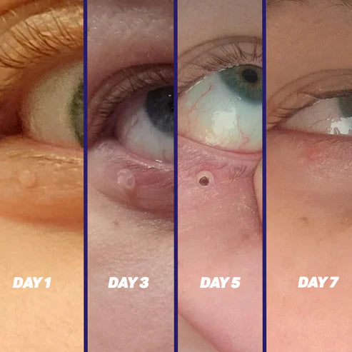 Skin Tag Remover bazona.com