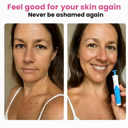 Skin Tag Remover Kit & Callus Remover