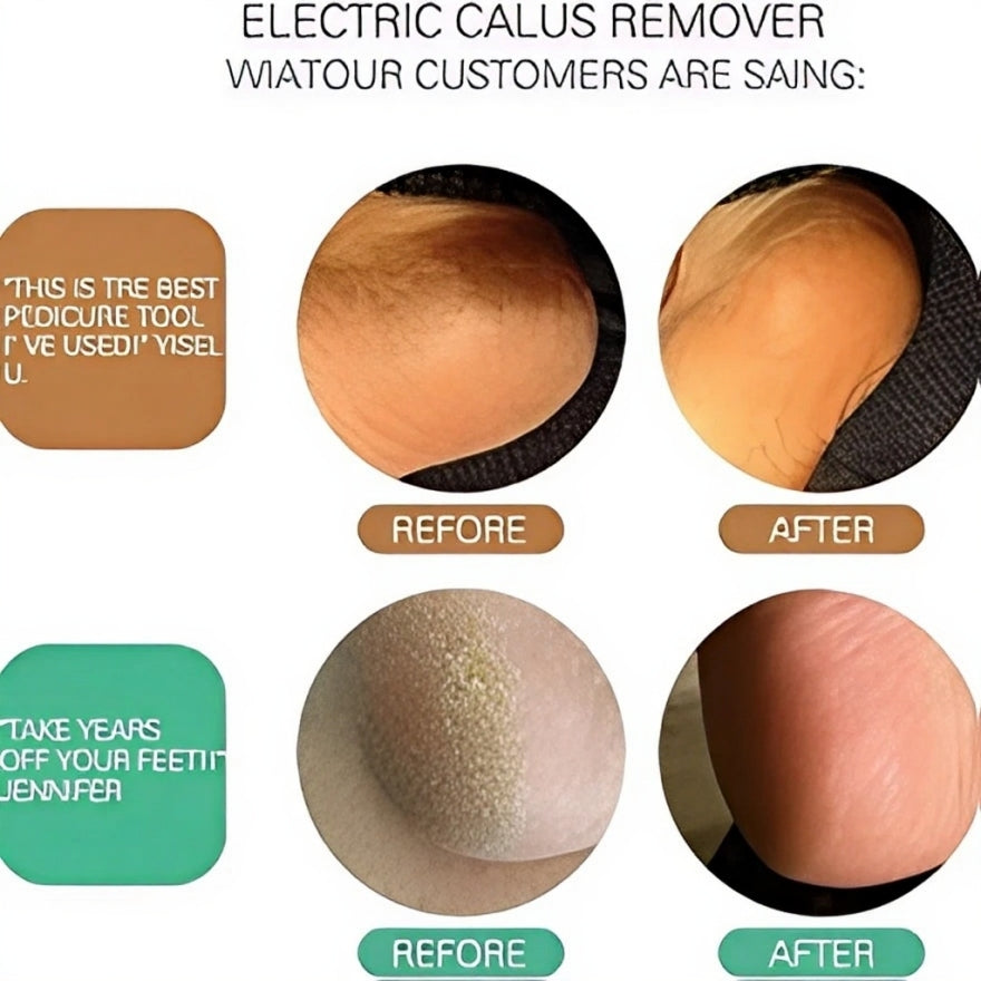 Skin Tag Remover Kit & Callus Remover