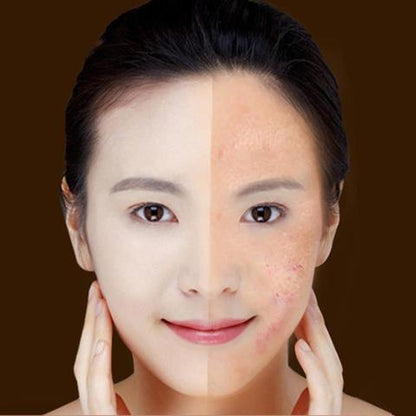 Blue Light Therapy Acne Laser Pen Soft Scar Wrinkle Removal Treatment Device Skin Care Beauty Equipment BAZONA