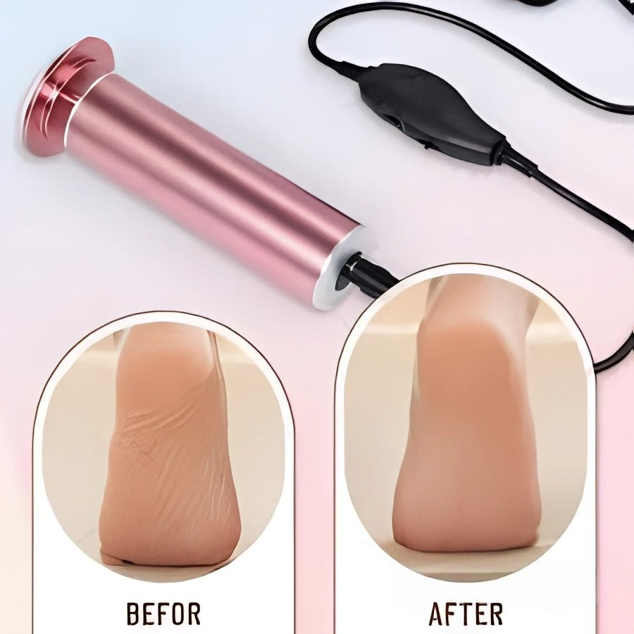 Skin Tag Remover Kit & Callus Remover