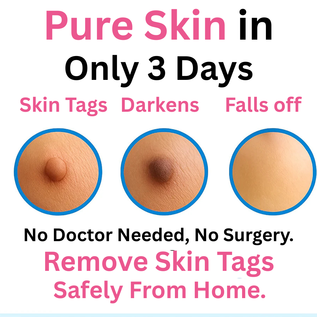 Skin Tag Remover Kit & Callus Remover
