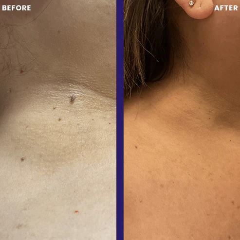 Before and After