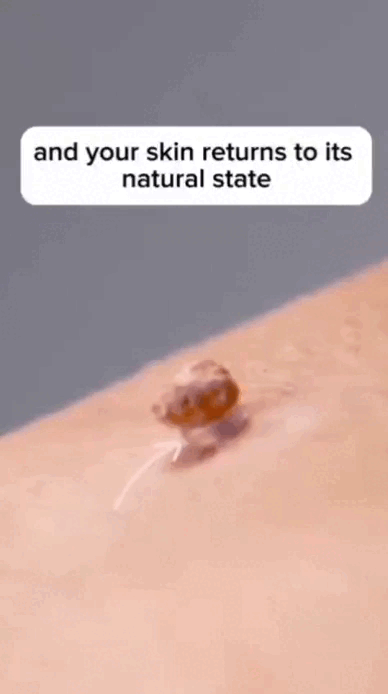 Skin Tag Remover
